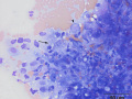 Lymphoma of granular lymphocytes (cat)