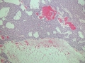 Hepatocellular carcinoma (histology)