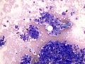 Hepatocellular carcinoma