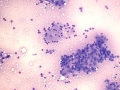 Hepatocellular carcinoma