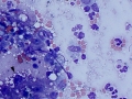 Inflammation