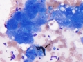 Cholestasis
