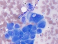Mesothelial hyperplasia