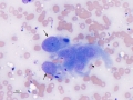 Sarcoma+mesothelial cell
