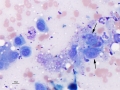 Sarcoma+mesothelial cells