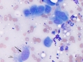 Sarcoma+mesothelial cells