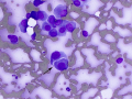 Plasma cell tumor