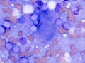 T cell lymphoma/leukemia