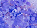T cell tumor and macrophage
