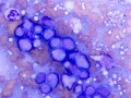 T cell lymphoma/leukemia