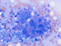 T cell lymphoma/leukemia