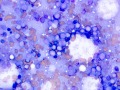 T cell lymphoma/leukemia