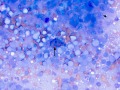 T cell tumor and necrosis