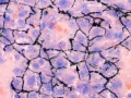 Cholestasis
