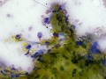 Bile aggregate
