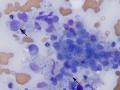 Histiocytic sarcoma