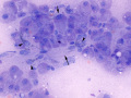 Hepatocellular carcinoma