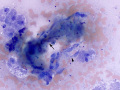 Necrosis & fibrosis