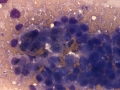 Hepatoblastoma