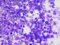 Acute myeloid leukemia (AML)