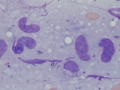 Histiocytic sarcoma