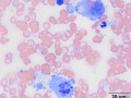 Histiocytic sarcoma