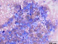 Histiocytic sarcoma