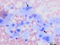 Histiocytic sarcoma