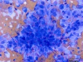 Histiocytic sarcoma