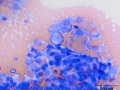 Histiocytic sarcoma