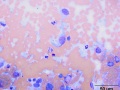 Histiocytic sarcoma