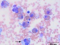 Histiocytic sarcoma
