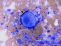 Histiocytic sarcoma