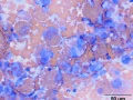 Histiocytic sarcoma