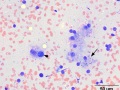 Multiple myeloma