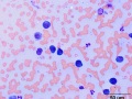 Multiple myeloma