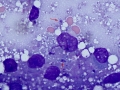 Toxoplasmosis