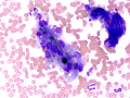 Cholestasis