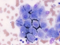 Cholestasis