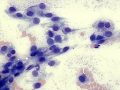 Fibrosis