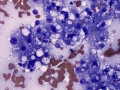 Inflammation