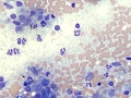 Mixed inflammation