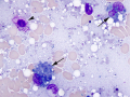 Lipofuscin in macrophages