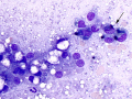 Lipogranuloma
