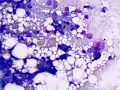 Suspect kupffer cell & mast cell