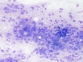 Histiocytic sarcoma