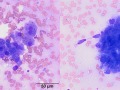 Pancreatic carcinoma & necrosis
