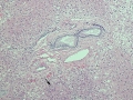 Fibrosis (histology)
