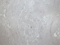 Hepatocellular carcinoma (histology)