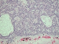 Hepatocellular carcinoma (histology)
